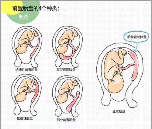 图片转自熊猫妈完全性前置胎盘:胎盘把宫颈内口全部覆盖,属于最严重